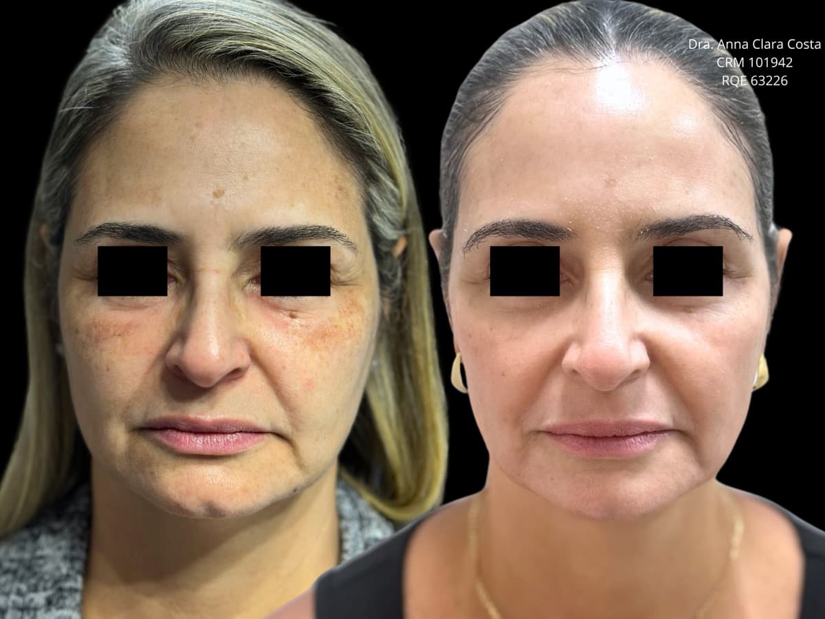 Antes e depois — tratamento de melasma e manchas