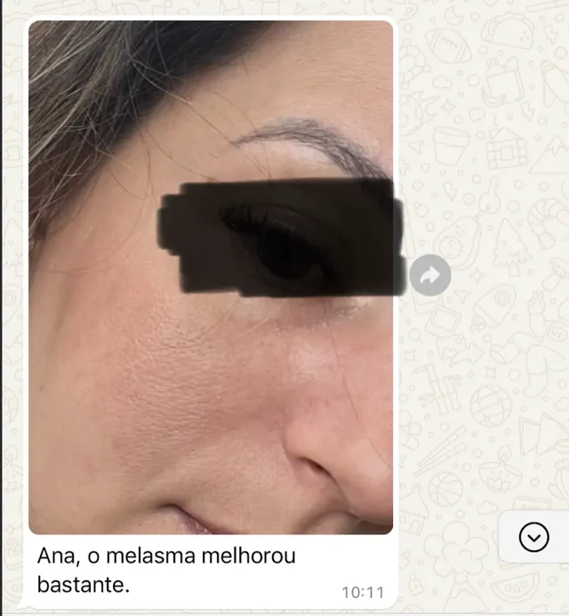 Print de WhatsApp — paciente relata melhora significativa do melasma