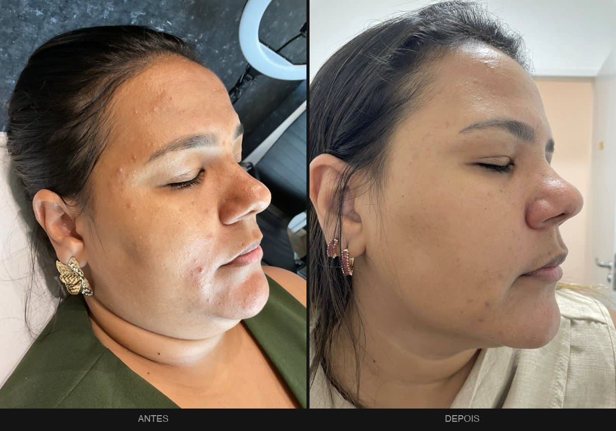 Antes e depois — tratamento de acne no rosto