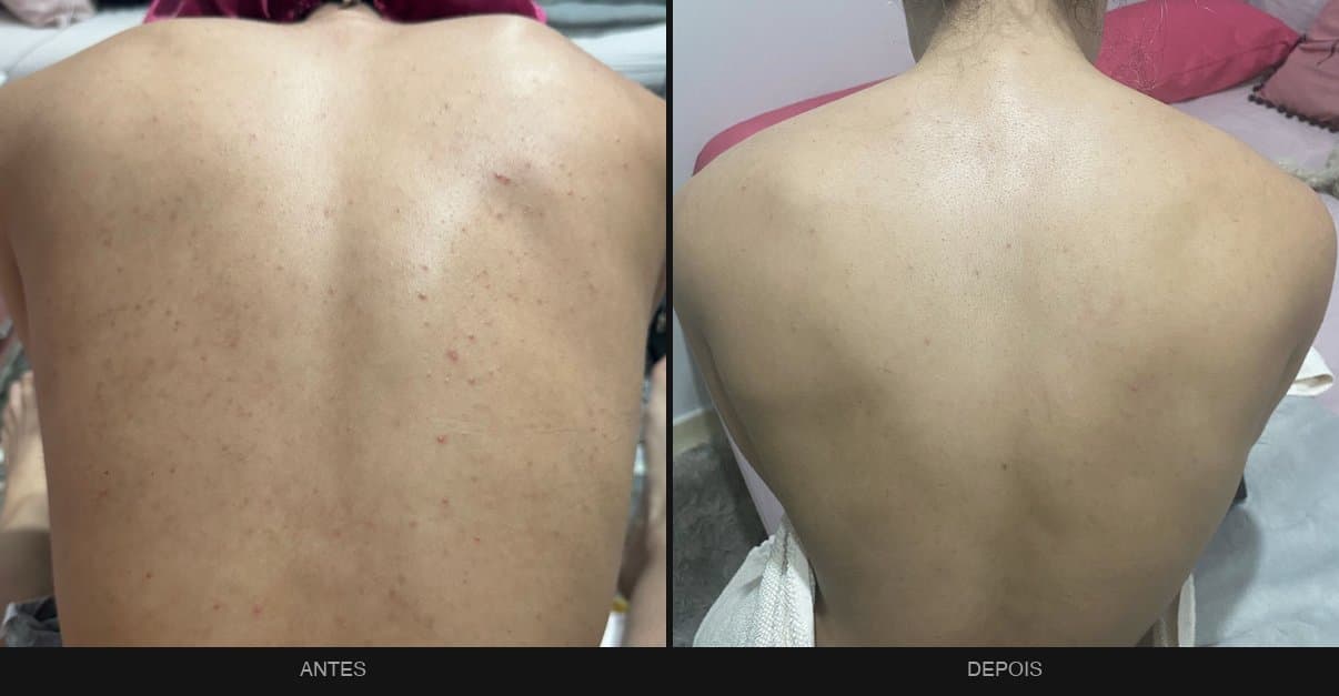Antes e depois — tratamento de acne nas costas