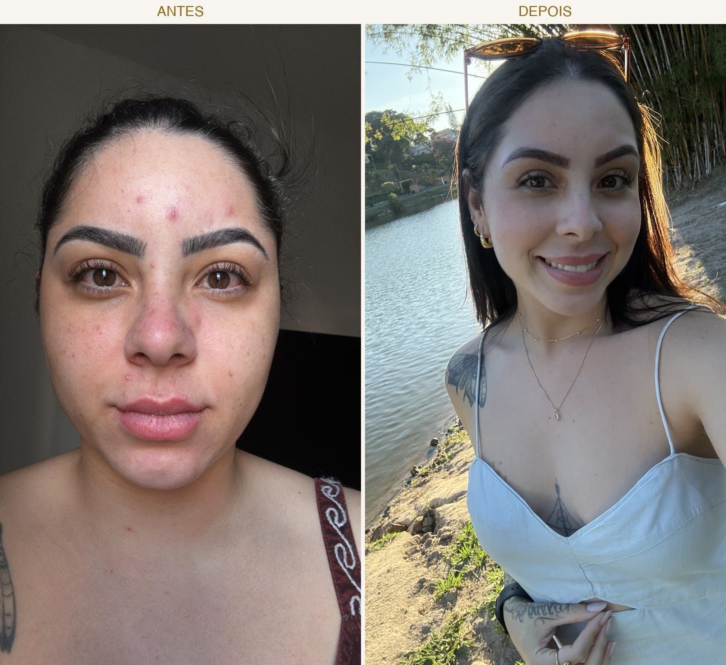 Antes e depois — tratamento de acne facial com espinhas